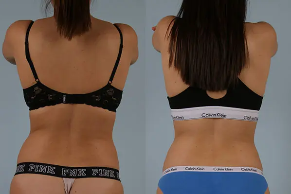 before and after coolsculpting back view female patient case 666