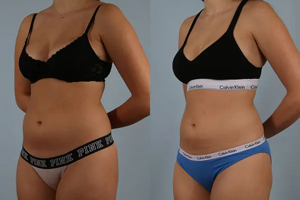 before and after coolsculpting left angle view female patient case 666