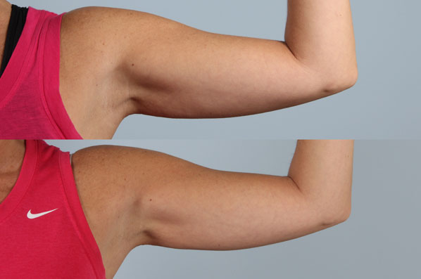 before and after coolsculpting left arm front view female patient case 673