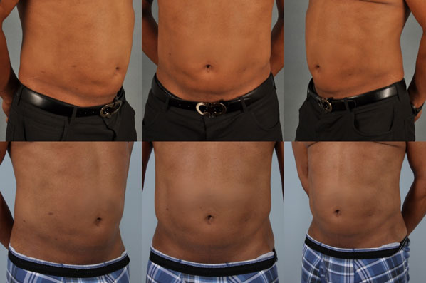 before and after coolsculpting front and side view male patient case 676