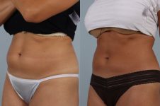 before and after coolsculpting left view female patient case 678
