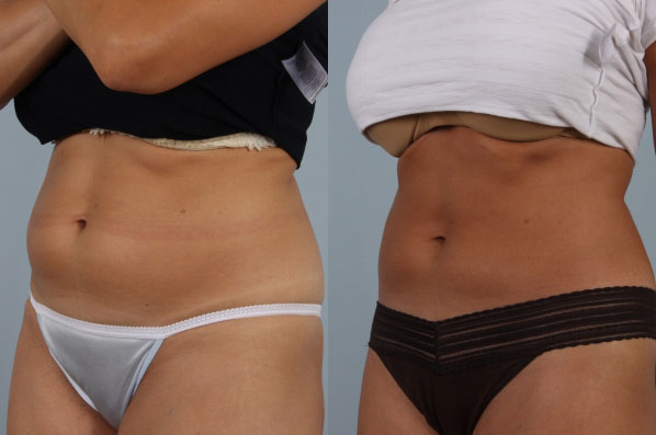 before and after coolsculpting left view female patient case 678