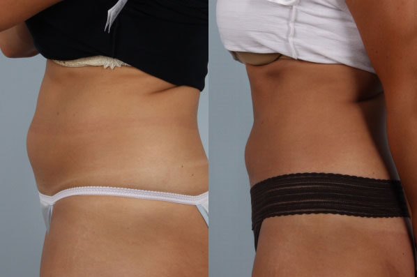 before and after coolsculpting left side view female patient case 678