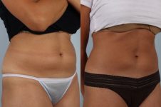 before and after coolsculpting right view female patient case 678