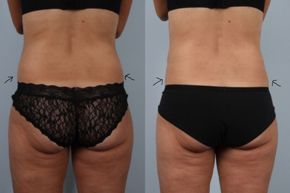 before and after coolsculpting back view female patient case 684