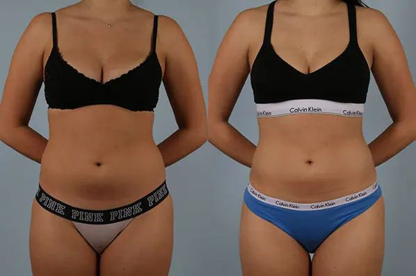 before and after CoolSculpting female patient front view case 666