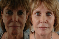 Before and After Eyelid Surgery Blepharoplasty Female Patient front view case 3466