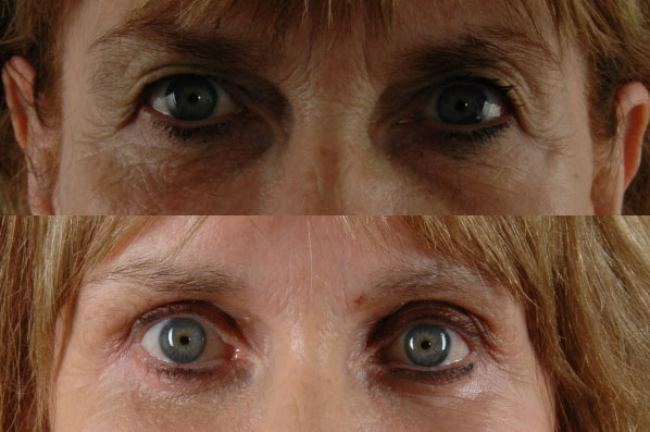 Before and After Eyelid Surgery Blepharoplasty Female Patient front view case 3466