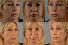 Before and After Eyelid Surgery Blepharoplasty Female Patient multiple angle view case 3470