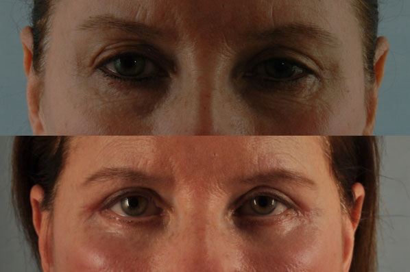 Before and After Eyelid Surgery Blepharoplasty Female Patient front view case 3474