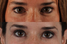Before and After Eyelid Surgery Blepharoplasty Female Patient front view case 3478