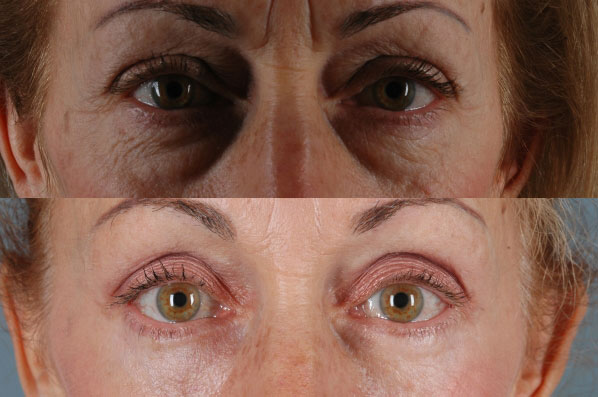 Before and After Eyelid Surgery Blepharoplasty Female Patient front view case 3486