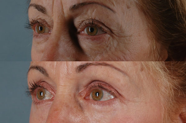 Before and After Eyelid Surgery Blepharoplasty Female Patient left diagonal view case 3486