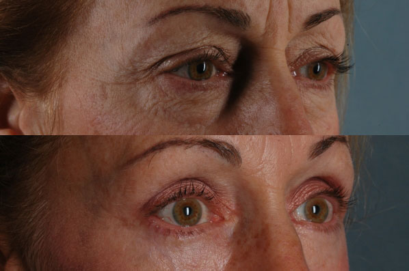 Before and After Eyelid Surgery Blepharoplasty Female Patient right diagonal view case 3486