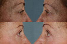 Before and After Eyelid Surgery Blepharoplasty Female Patient left and right side view case 3486