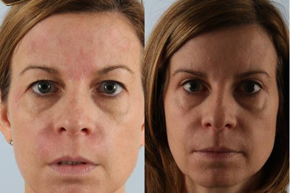 Before and After Eyelid Surgery Blepharoplasty Female Patient Front View Case 3491