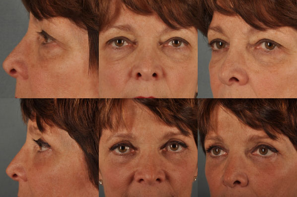 Before and After Eyelid Surgery Blepharoplasty Female Patient multiple angle view case 3498