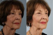 Before and After Eyelid Surgery Blepharoplasty Female Patient right angle view case 3501