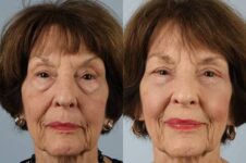 Before and After Eyelid Surgery Blepharoplasty Female Patient front view case 3501