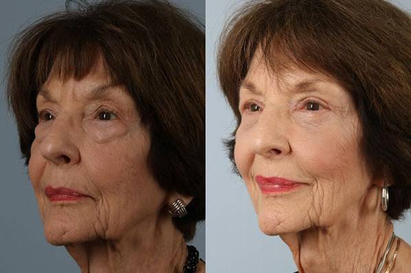 Before and After Eyelid Surgery Blepharoplasty Female Patient left angle view case 3501