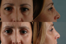 Before and After Eyelid Surgery Blepharoplasty Female Patient front and right side view case 3508