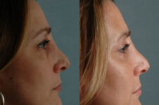 Before and After Eyelid Surgery Blepharoplasty Female Patient right side view case 3508