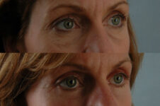Before and After Eyelid Surgery Blepharoplasty Female Patient right angled view case 3516