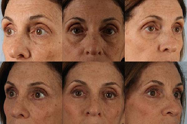 Before and After Eyelid Surgery Blepharoplasty Female Patient multiple angle view case 3519