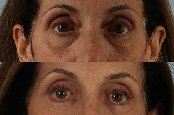 Before and After Eyelid Surgery Blepharoplasty Female Patient front view case 3519