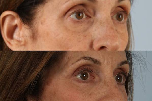 Before and After Eyelid Surgery Blepharoplasty Female Patient right diagonal view case 3519