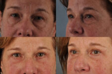 Before and After Eyelid Surgery Blepharoplasty Female Patient Front and Left Angle view case 3528