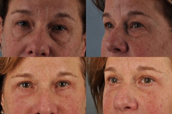 Before and After Eyelid Surgery Blepharoplasty Female Patient Front and Left Angle view case 3528