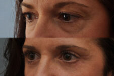 Before and After Eyelid Surgery Blepharoplasty Female Patient left diagonal view case 3531
