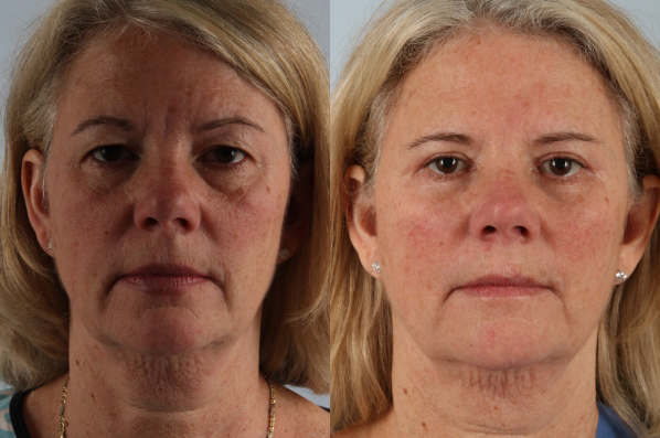 Before and After Eyelid Surgery Blepharoplasty Female Patient front view case 3535