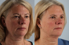 Before and After Eyelid Surgery Blepharoplasty Female Patient right diagonal view case 3535