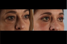Before and After Eyelid Surgery Blepharoplasty Female Patient right angle view case 3544