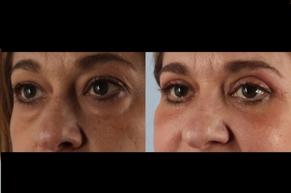 Before and After Eyelid Surgery Blepharoplasty Female Patient left angle view case 3544