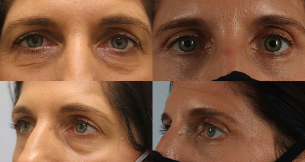eyelid surgery before and after case 3568