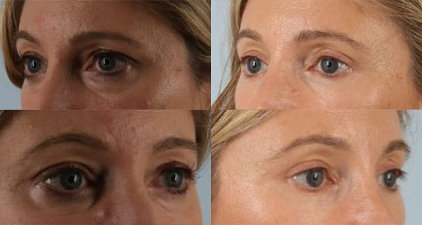 eyelid surgery before and after case 3558