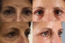 before and after eyelid surgery female patient multiple angles case 3575