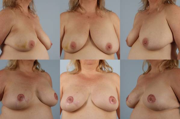 before and after breast reconstruction female patient multiple angle view case 3226