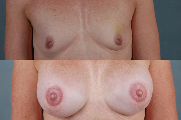 before and after breast reconstruction female patient front view case 3245
