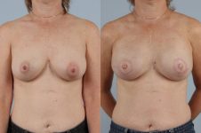 before and after breast reconstruction female patient front view case 3252