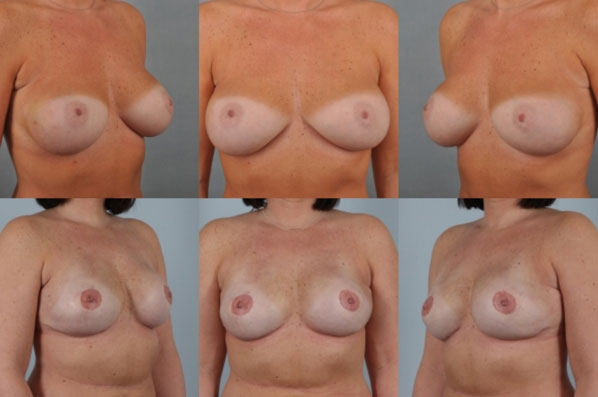 before and after breast reconstruction female patient multiple angle view case 3257