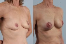 before and after breast reconstruction female patient right diagonal view case 3259