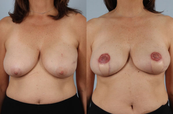 before and after breast reconstruction female patient front view case 3265