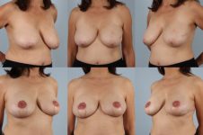 before and after breast reconstruction female patient multiple angle view case 3265