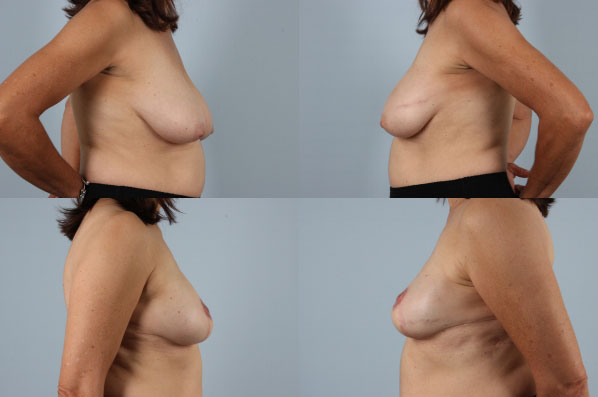 before and after breast reconstruction female patient left and right side view case 3265