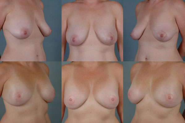 before and after breast reconstruction female patient multiple angle view case 3287