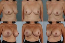 before and after breast reconstruction female patient multiple angle view case 3295